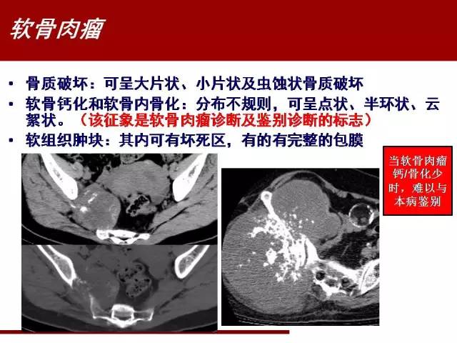 【病例】骶髂关节滑膜肉瘤1例影像表现 【病例】骶髂关节滑膜肉瘤1例影像表现