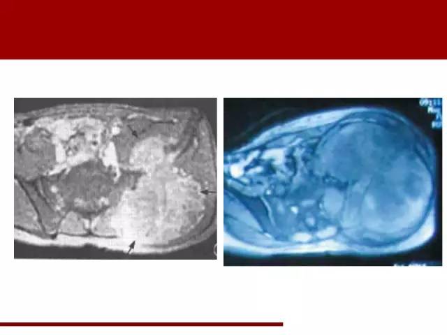 【病例】骶髂关节滑膜肉瘤1例影像表现 【病例】骶髂关节滑膜肉瘤1例影像表现