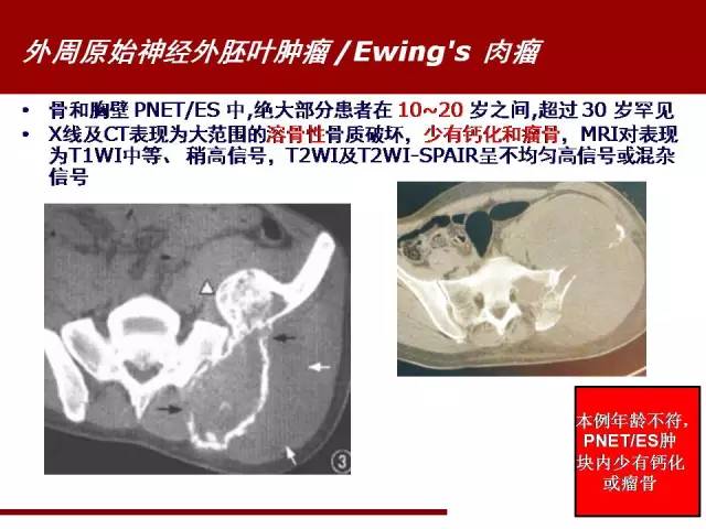 【病例】骶髂关节滑膜肉瘤1例影像表现 【病例】骶髂关节滑膜肉瘤1例影像表现