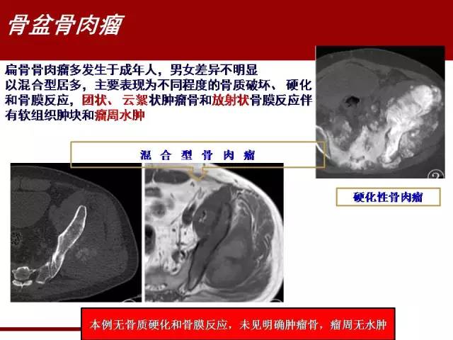 【病例】骶髂关节滑膜肉瘤1例影像表现 【病例】骶髂关节滑膜肉瘤1例影像表现
