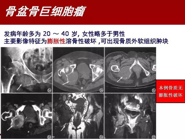 【病例】骶髂关节滑膜肉瘤1例影像表现 【病例】骶髂关节滑膜肉瘤1例影像表现