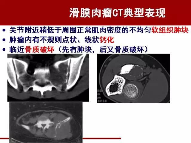 【病例】骶髂关节滑膜肉瘤1例影像表现 【病例】骶髂关节滑膜肉瘤1例影像表现