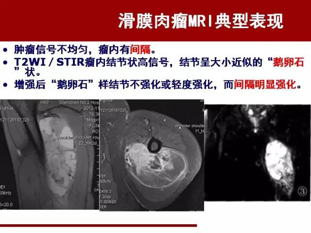 【病例】骶髂关节滑膜肉瘤1例影像表现 【病例】骶髂关节滑膜肉瘤1例影像表现