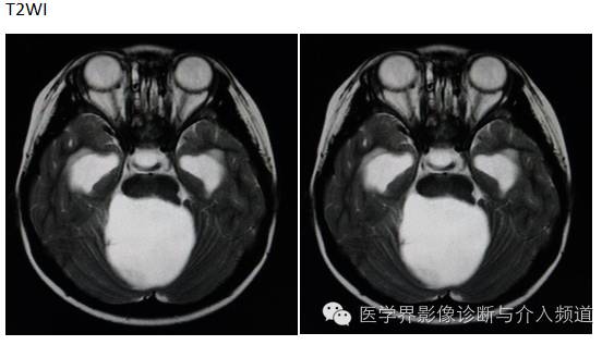 【病例】小脑毛细胞型星形细胞瘤1例MR影像表现