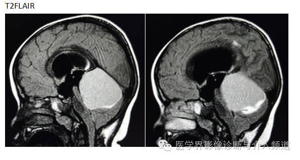 【病例】小脑毛细胞型星形细胞瘤1例MR影像表现