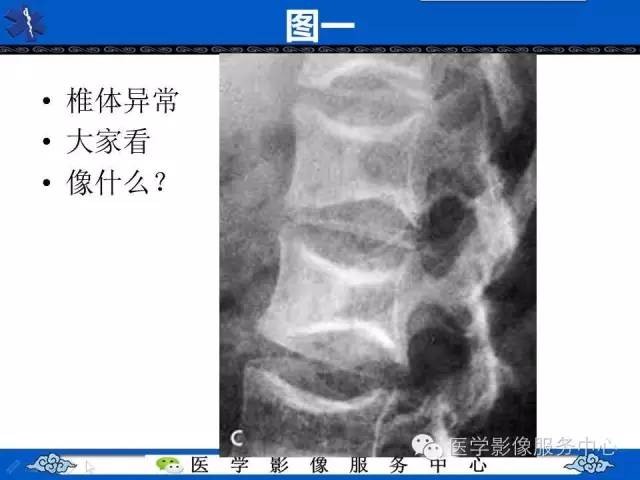【影像征象】鱼口征——镰状细胞病