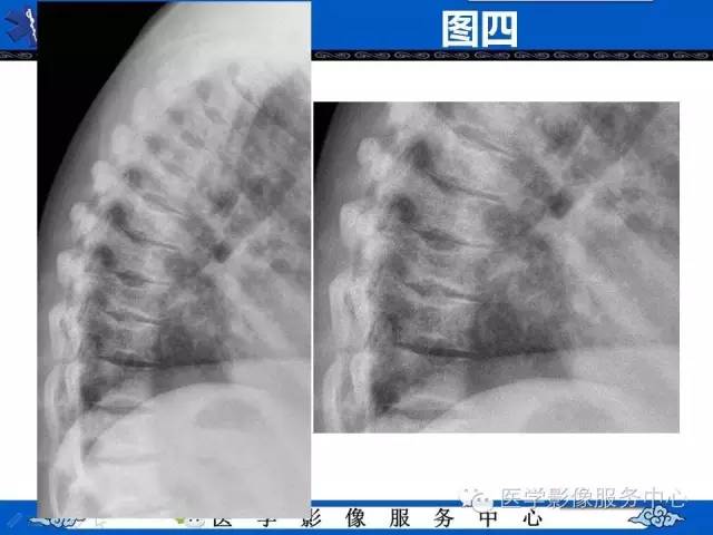 【影像征象】鱼口征——镰状细胞病