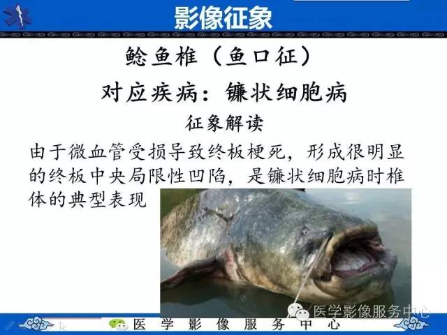 【影像征象】鱼口征——镰状细胞病