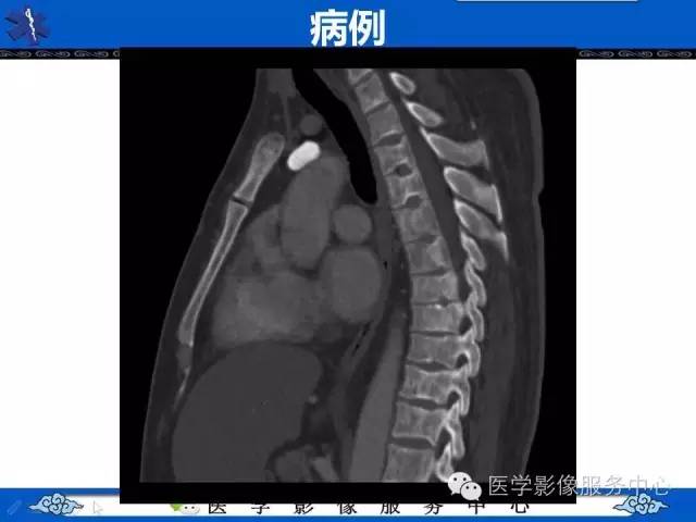 【影像征象】鱼口征——镰状细胞病