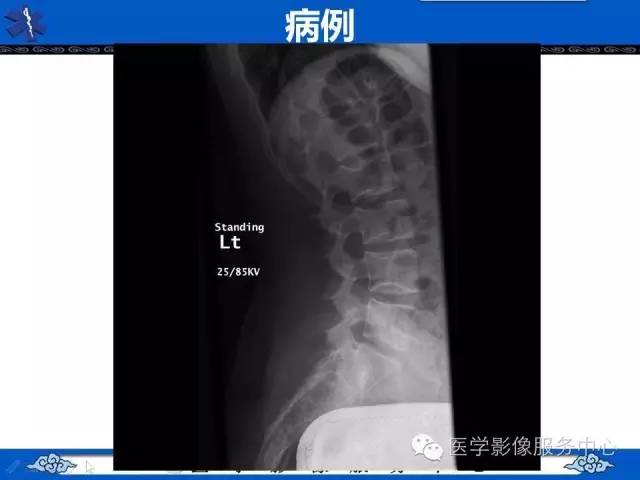 【影像征象】鱼口征——镰状细胞病