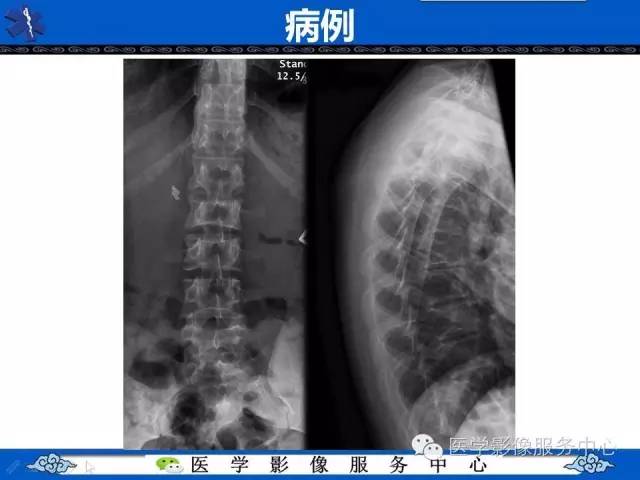【影像征象】鱼口征——镰状细胞病