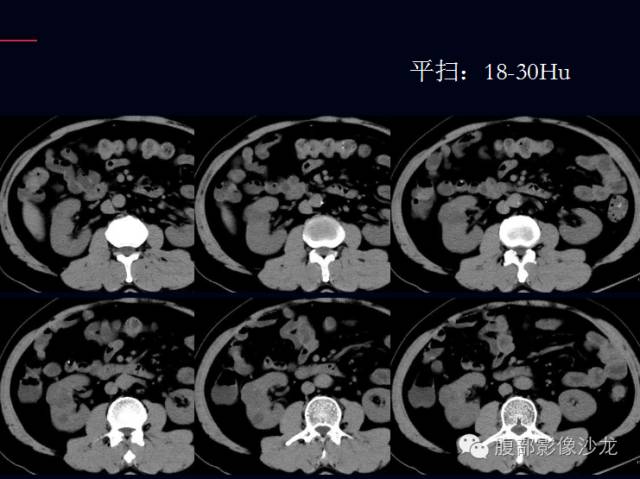 【病例】右肾多房性囊性肾细胞癌1例CT影像表现 【病例】右肾多房性囊性肾细胞癌1例CT影像表现