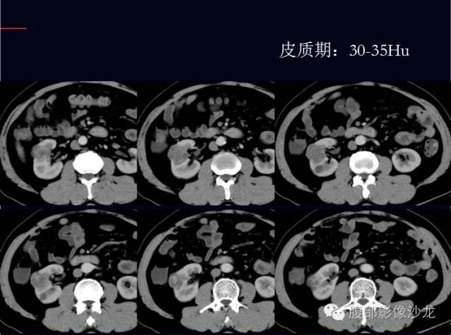 【病例】右肾多房性囊性肾细胞癌1例CT影像表现 【病例】右肾多房性囊性肾细胞癌1例CT影像表现