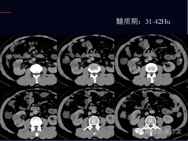 【病例】右肾多房性囊性肾细胞癌1例CT影像表现 【病例】右肾多房性囊性肾细胞癌1例CT影像表现