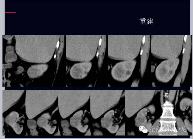 【病例】右肾多房性囊性肾细胞癌1例CT影像表现 【病例】右肾多房性囊性肾细胞癌1例CT影像表现