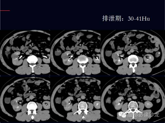 【病例】右肾多房性囊性肾细胞癌1例CT影像表现 【病例】右肾多房性囊性肾细胞癌1例CT影像表现