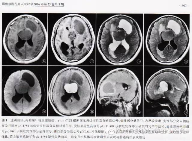 【病例】脑室内外占位性病变——精原细胞瘤1例