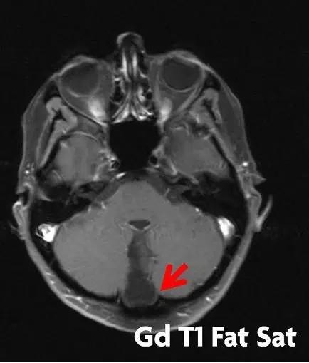 【病例】颅内皮样囊肿破裂1例MR影像表现 【病例】颅内皮样囊肿破裂1例MR影像表现