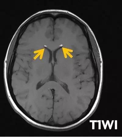 【病例】颅内皮样囊肿破裂1例MR影像表现 【病例】颅内皮样囊肿破裂1例MR影像表现