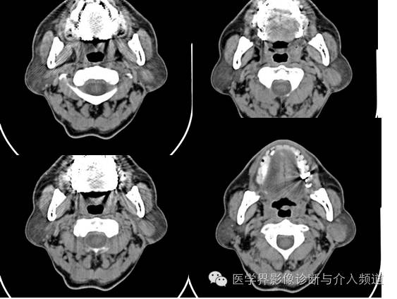 【病例】左腮腺Warthin瘤1例CT影像表现