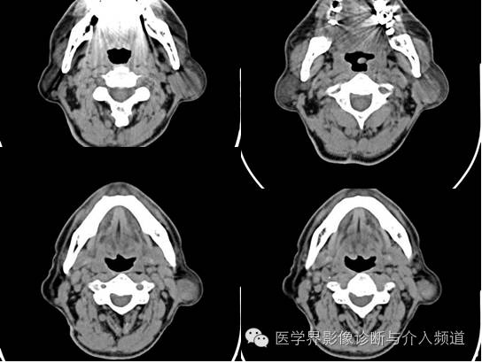 【病例】左腮腺Warthin瘤1例CT影像表现 【病例】左腮腺Warthin瘤1例CT影像表现