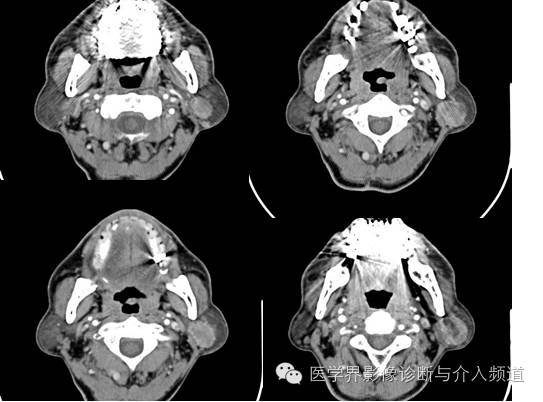 【病例】左腮腺Warthin瘤1例CT影像表现 【病例】左腮腺Warthin瘤1例CT影像表现