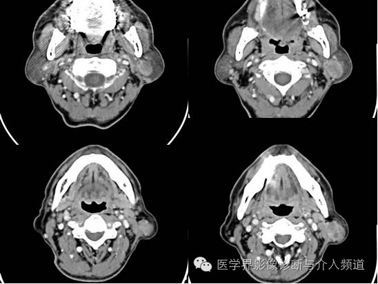 【病例】左腮腺Warthin瘤1例CT影像表现 【病例】左腮腺Warthin瘤1例CT影像表现