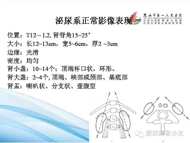 【PPT】64层螺旋CT血管成像对马蹄肾供血动脉的解剖学观察 【PPT】64层螺旋CT血管成像对马蹄肾供血动脉的解剖学观察