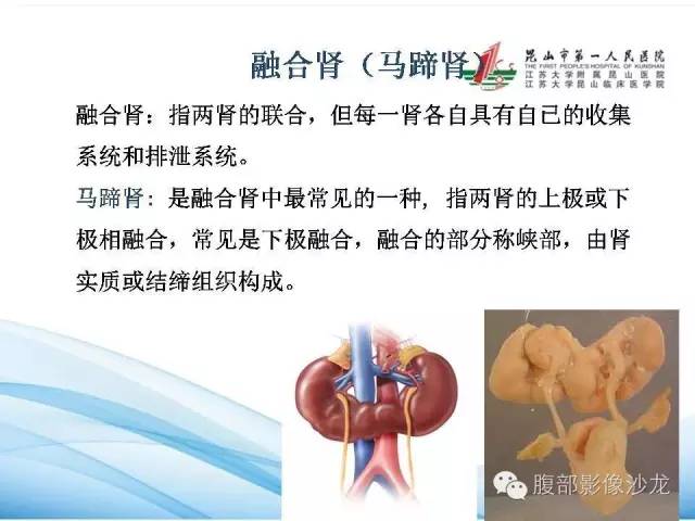 【PPT】64层螺旋CT血管成像对马蹄肾供血动脉的解剖学观察 【PPT】64层螺旋CT血管成像对马蹄肾供血动脉的解剖学观察