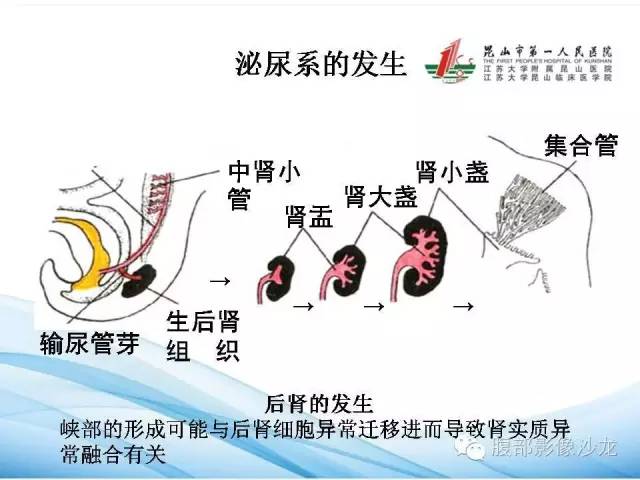 【PPT】64层螺旋CT血管成像对马蹄肾供血动脉的解剖学观察 【PPT】64层螺旋CT血管成像对马蹄肾供血动脉的解剖学观察