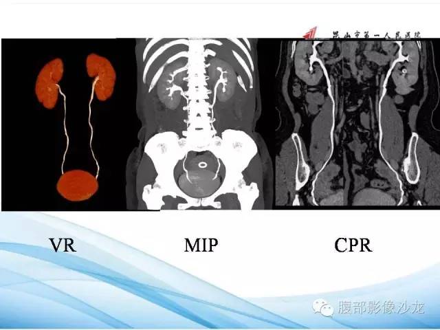 【PPT】64层螺旋CT血管成像对马蹄肾供血动脉的解剖学观察 【PPT】64层螺旋CT血管成像对马蹄肾供血动脉的解剖学观察