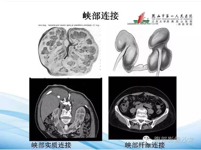 【PPT】64层螺旋CT血管成像对马蹄肾供血动脉的解剖学观察 【PPT】64层螺旋CT血管成像对马蹄肾供血动脉的解剖学观察