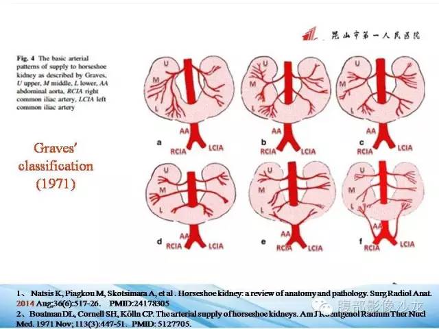 【PPT】64层螺旋CT血管成像对马蹄肾供血动脉的解剖学观察 【PPT】64层螺旋CT血管成像对马蹄肾供血动脉的解剖学观察