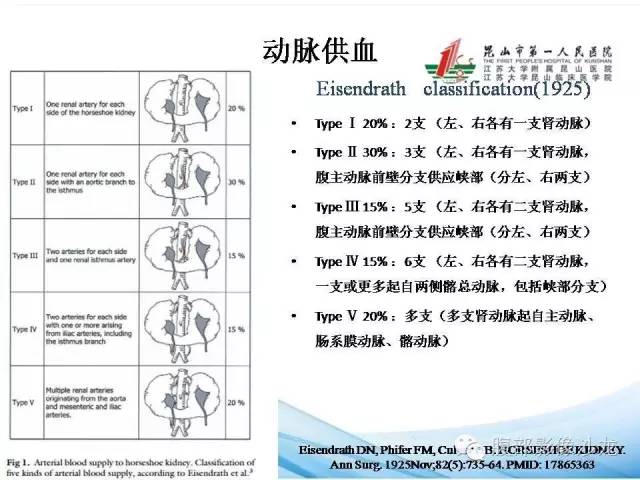【PPT】64层螺旋CT血管成像对马蹄肾供血动脉的解剖学观察 【PPT】64层螺旋CT血管成像对马蹄肾供血动脉的解剖学观察