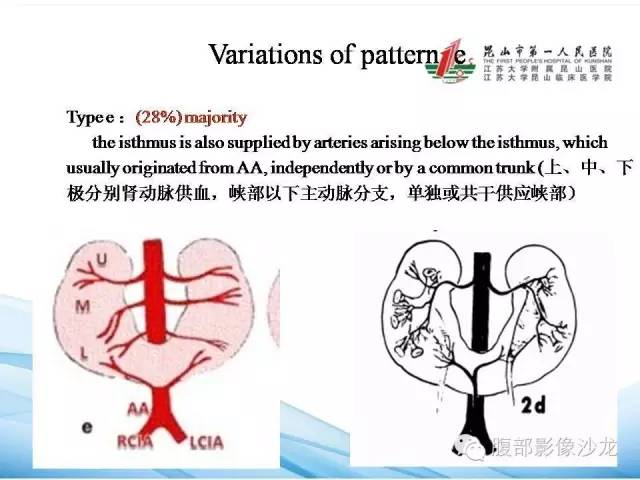 【PPT】64层螺旋CT血管成像对马蹄肾供血动脉的解剖学观察 【PPT】64层螺旋CT血管成像对马蹄肾供血动脉的解剖学观察