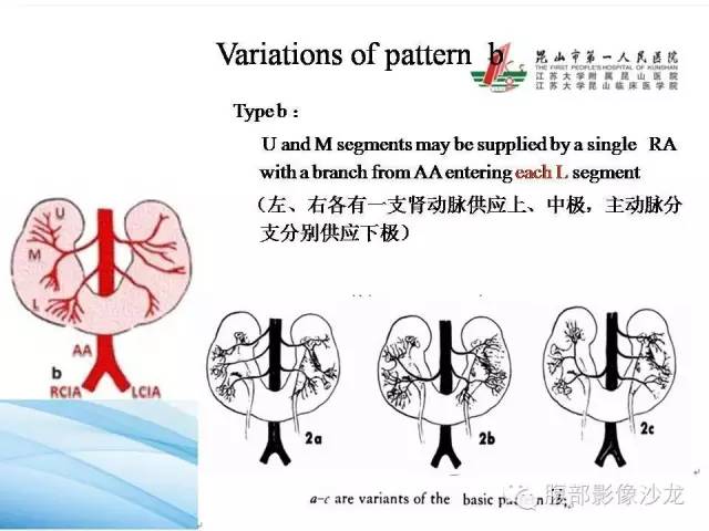 【PPT】64层螺旋CT血管成像对马蹄肾供血动脉的解剖学观察 【PPT】64层螺旋CT血管成像对马蹄肾供血动脉的解剖学观察