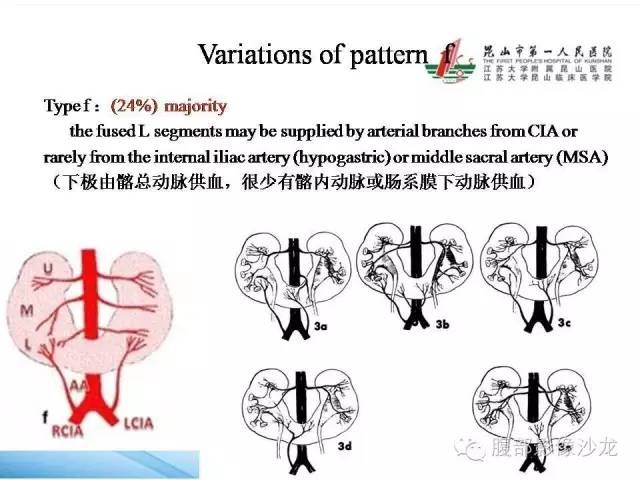 【PPT】64层螺旋CT血管成像对马蹄肾供血动脉的解剖学观察 【PPT】64层螺旋CT血管成像对马蹄肾供血动脉的解剖学观察