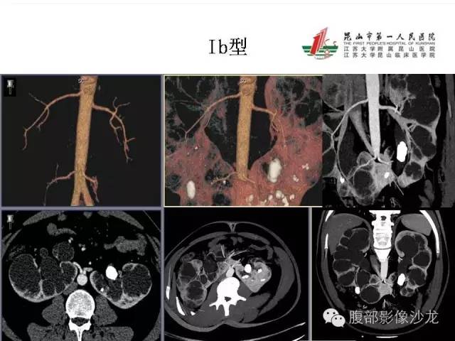 【PPT】64层螺旋CT血管成像对马蹄肾供血动脉的解剖学观察 【PPT】64层螺旋CT血管成像对马蹄肾供血动脉的解剖学观察