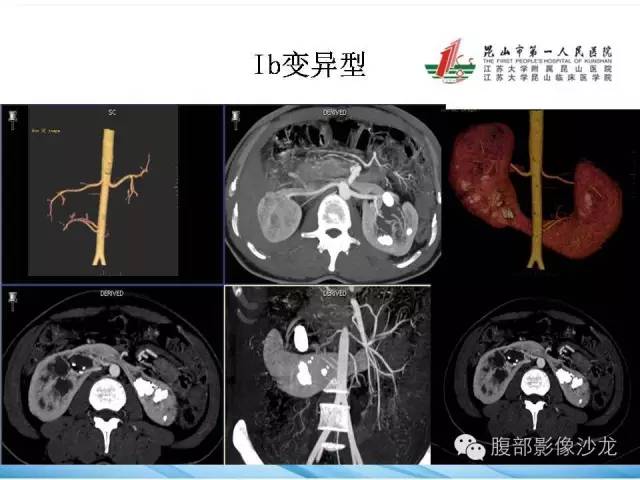【PPT】64层螺旋CT血管成像对马蹄肾供血动脉的解剖学观察 【PPT】64层螺旋CT血管成像对马蹄肾供血动脉的解剖学观察