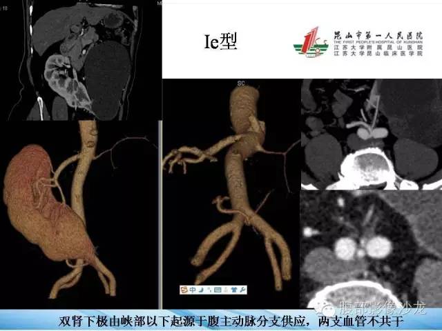【PPT】64层螺旋CT血管成像对马蹄肾供血动脉的解剖学观察 【PPT】64层螺旋CT血管成像对马蹄肾供血动脉的解剖学观察