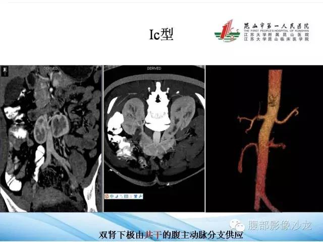 【PPT】64层螺旋CT血管成像对马蹄肾供血动脉的解剖学观察 【PPT】64层螺旋CT血管成像对马蹄肾供血动脉的解剖学观察