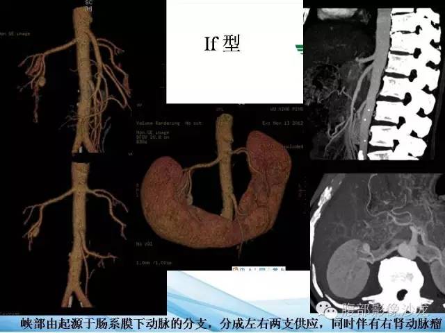 【PPT】64层螺旋CT血管成像对马蹄肾供血动脉的解剖学观察 【PPT】64层螺旋CT血管成像对马蹄肾供血动脉的解剖学观察
