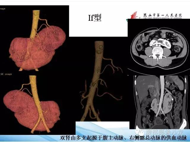 【PPT】64层螺旋CT血管成像对马蹄肾供血动脉的解剖学观察 【PPT】64层螺旋CT血管成像对马蹄肾供血动脉的解剖学观察