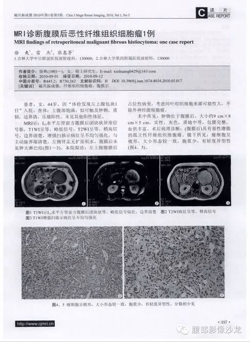 【病例】腹膜后未分化多形性肉瘤1例CT影像表现 【病例】腹膜后未分化多形性肉瘤1例CT影像表现