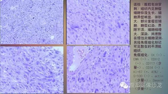 【病例】腹膜后未分化多形性肉瘤1例CT影像表现 【病例】腹膜后未分化多形性肉瘤1例CT影像表现