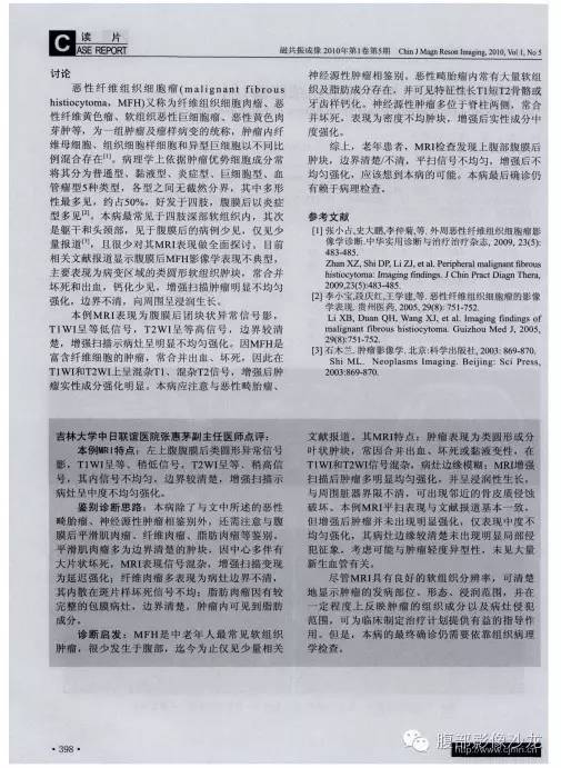 【病例】腹膜后未分化多形性肉瘤1例CT影像表现 【病例】腹膜后未分化多形性肉瘤1例CT影像表现