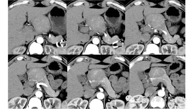 【病例】胰腺结核1例MR影像表现