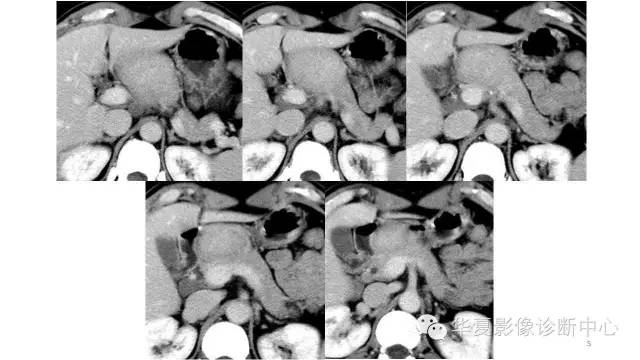 【病例】胰腺结核1例MR影像表现
