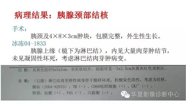 【病例】胰腺结核1例MR影像表现