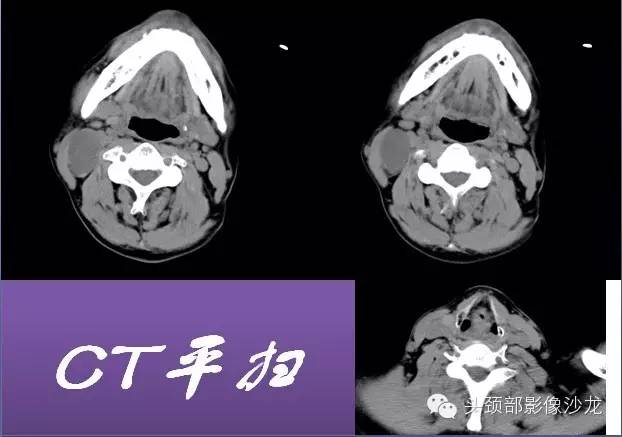 【病例】右颈部异位甲状腺1例CT影像表现